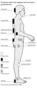 areas of the body where pressure ulcers can easily develop