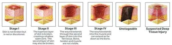 different grades of pressure sore