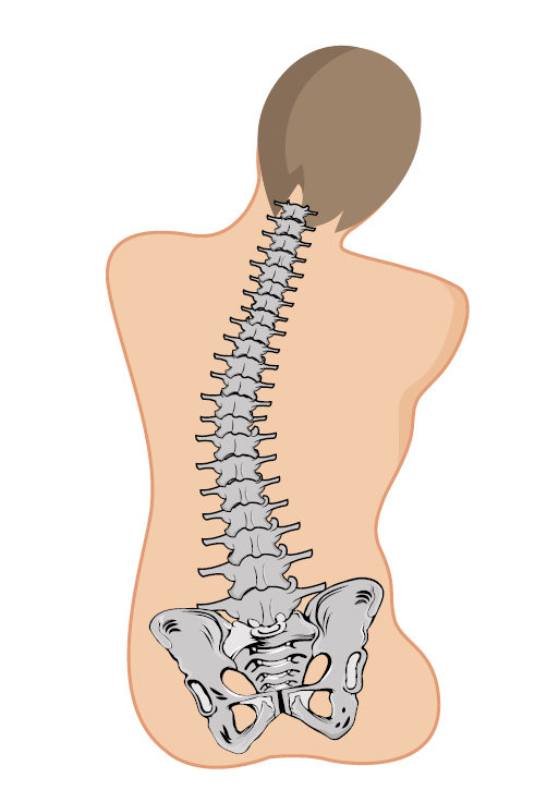 Scoliotic spine