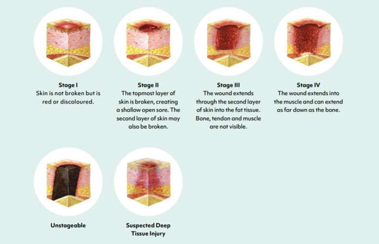 How Medical Airflow Mattresses Relieve Pressure Ulcers - Vivid Care