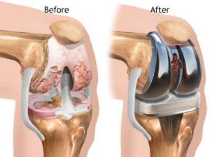 diagram showing before and after a knee replacement